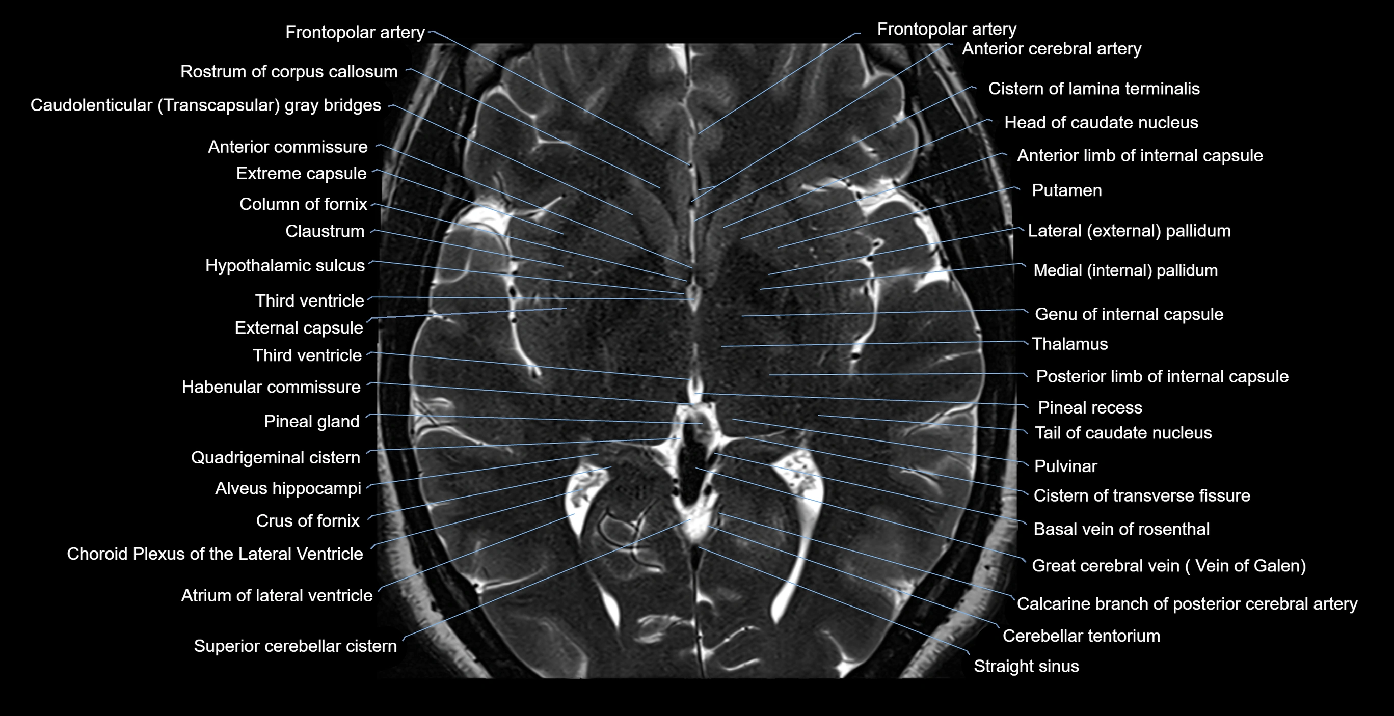 brain axial anatomy 3T MRI images -img-17001-00031.webp